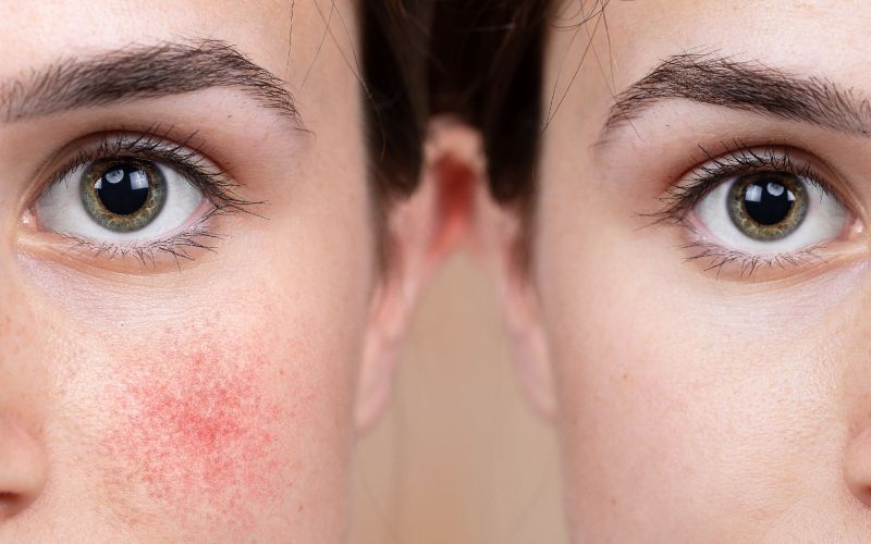 Egy makacs bőrprobléma: a rosacea
