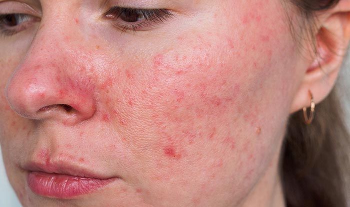 Április a rosacea tudatosság hónapja